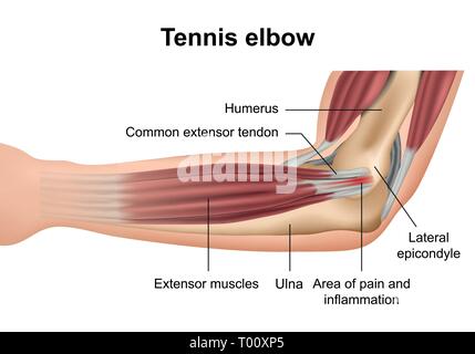 Il gomito del tennista pregiudizio medical illustrazione vettoriale su sfondo bianco Illustrazione Vettoriale