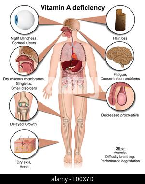 La vitamina A corpo deviciency effetti medici illustrazione vettoriale su sfondo bianco Illustrazione Vettoriale