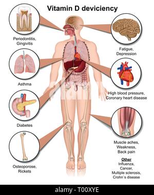 La vitamina D deviciency effetti del corpo medico illustrazione vettoriale su sfondo bianco Illustrazione Vettoriale