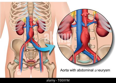 Aortic aneurisma addominale 3d medical illustrazione vettoriale isolati su sfondo bianco Illustrazione Vettoriale