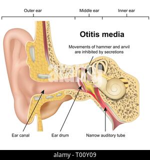 Otite media malattia orecchio 3d medical illustrazione vettoriale su sfondo bianco Illustrazione Vettoriale