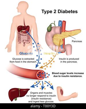 Il diabete di tipo 2 medical illustrazione vettoriale con descrizione in inglese Illustrazione Vettoriale