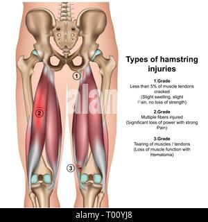 Tipi di injurys posteriori della coscia 3d medical illustrazione vettoriale su sfondo bianco Illustrazione Vettoriale