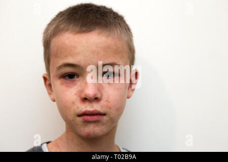 Ritratto di malati triste bambino affette da morbillo o varicella con dossi su tutta la faccia. Contagiosa malattie del bambino e il trattamento. Foto Stock