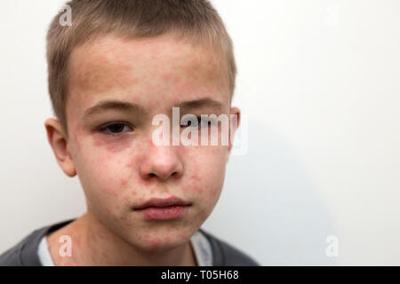 Ritratto di malati triste bambino affette da morbillo o varicella con dossi su tutta la faccia. Contagiosa malattie del bambino e il trattamento. Foto Stock