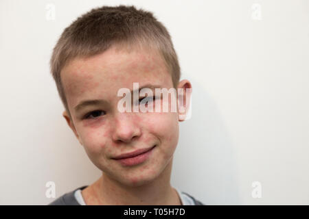 Ritratto di malati sorridente bambino affette da morbillo o varicella con dossi su tutta la faccia. Contagiosa malattie del bambino e il trattamento. Foto Stock