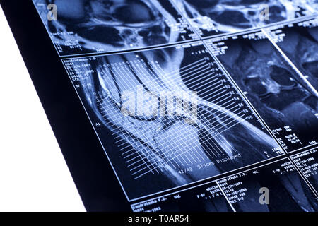 Il mio ginocchio MRI - sport trauma, danno di a forma di croce legamenti Foto Stock