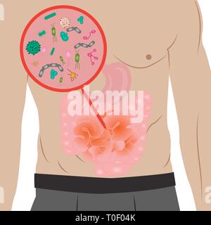 Infezione da arresto di overgrowth nell intestino illustrazione vettoriale . Apparato gastrointestinale Disordini digestivi Illustrazione Vettoriale