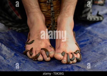 Marzo 21, 2019 - Srinagar, Jammu e Kashmir India - un paziente del Kashmir visto con le sanguisughe sui suoi piedi durante il trattamento di sanguisuga.un tradizionale lavoratore di salute utilizza le sanguisughe per succhiare il sangue impuro come parte di un trattamento a Hazratbal sulle rive del Dal lago nella periferia di Srinagar capitale estiva dell indiano Kashmir amministrato. Ogni anno tradizionali di operatori sanitari in Kashmir per utilizzare le sanguisughe per curare la gente per il prurito, dolorose dei grumi che si sviluppano sulla pelle chiamato chilblains acquisite durante l'inverno. Migliaia di pazienti che soffrono di vari problemi della pelle riceve leech trattamento a Hazratbal Foto Stock