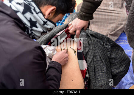 Marzo 21, 2019 - Srinagar, Jammu e Kashmir India - un paziente del Kashmir visto con le sanguisughe sulla sua schiena durante il trattamento di sanguisuga.un tradizionale lavoratore di salute utilizza le sanguisughe per succhiare il sangue impuro come parte di un trattamento a Hazratbal sulle rive del Dal lago nella periferia di Srinagar capitale estiva dell indiano Kashmir amministrato. Ogni anno tradizionali di operatori sanitari in Kashmir per utilizzare le sanguisughe per curare la gente per il prurito, dolorose dei grumi che si sviluppano sulla pelle chiamato chilblains acquisite durante l'inverno. Migliaia di pazienti che soffrono di vari problemi della pelle riceve leech trattamento a Hazratbal Foto Stock