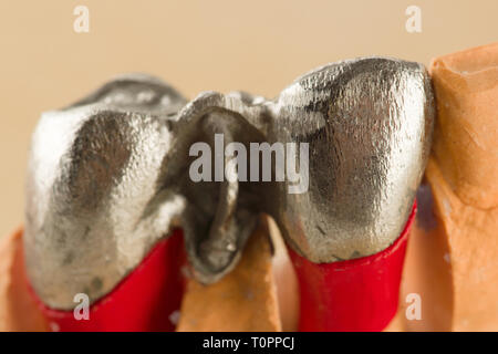 Artificiale di acciaio la corona dentale per la dentizione restauro nel lavoro Foto Stock