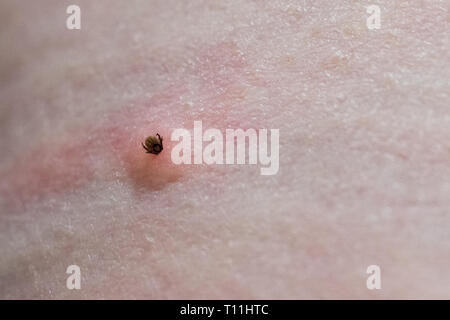 Ixodes richinus - Pecore tick, deer tick o Castor bean tick - sepolto nel maschio pelle umana alimentare sul sangue - Scozia, Regno Unito Foto Stock