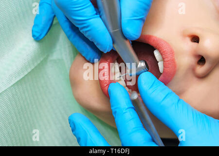 Dentista tratta la donna di denti. Ragazza giovane con la bocca aperta. Denti bianchi. Dentista mani closeup. Dental Clinic. Foto Stock