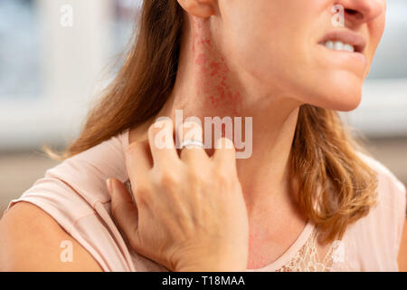 Donna bionda che indossa anello sul dito avente rash sul collo Foto Stock