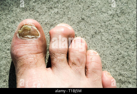 Vista dettagliata del brutto maschio i piedi e le dita erano colpiti dalla punta del fungo del chiodo e arhtritic hammertoes Foto Stock