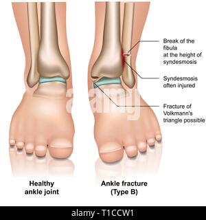 Articolazione della caviglia frattura medical illustrazione vettoriale su sfondo bianco Illustrazione Vettoriale