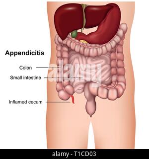 Appendicite 3d medical illustrazione vettoriale isolati su sfondo bianco Illustrazione Vettoriale