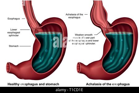 Da acalasia 3d medical illustrazione vettoriale su sfondo bianco Illustrazione Vettoriale