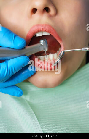 Dentista tratta la donna di denti. Ragazza giovane con la bocca aperta. Denti bianchi. Le mani di close-up di dentista. Dental Clinic. Foto Stock