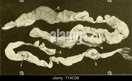 Le malattie dell'apparato genitale le malattie degli organi genitali degli animali domestici diseasesofgenita00sarà Anno: 1921 il generale infezioni degli organi genitali esterni della specie suina 747 Fig. 221-necrotiche embrioni di suini. /, 2, Necrotic embrioni (membrane incisi per portarle in vista) j, un embrionale necrotico sac in cui l'embrione non può essere trovato ; 7, 5, feti sani dalla stessa utero. Foto Stock