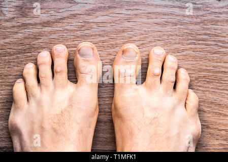 Piedi di uomo a piedi nudi con psoriasi dermatite sulle sue dita. Foto Stock