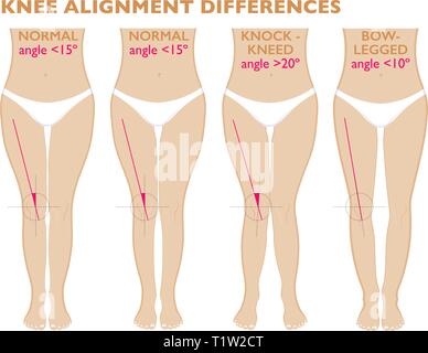 Gambe e gli angoli delle ginocchia, diversi tipi di forme di gamba. Vista frontale girl, anatomia del corpo. Il normale varo e valgo Illustrazione Vettoriale