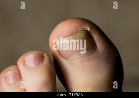 Piedi vicino. Le unghie dei piedi maschio con toenail danni. La salute e il concetto di benessere. Foto Stock