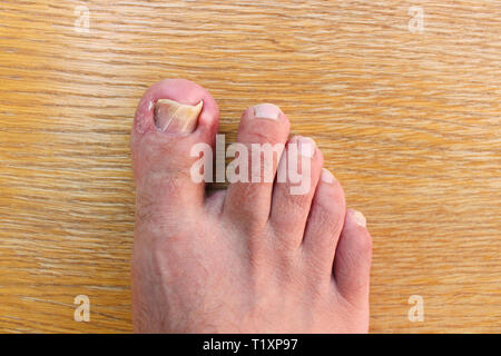 Danneggiato toenail. Il pollice sull'uomo della gamba. Vista dall'alto. Foto Stock