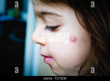 Varicella spot faccia bambino guancia laterale Foto Stock