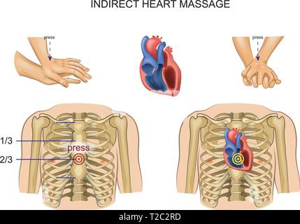 Illustrazione vettoriale di indiretta il massaggio cardiaco. regolamento Illustrazione Vettoriale