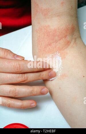 Donna applicazione di unguento di eczema in corrispondenza del gomito, Germania Foto Stock