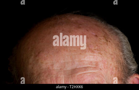 Le patch di pelle scoloriti sulla fronte di un uomo più anziano precancerosi sun danno vicino. Foto Stock