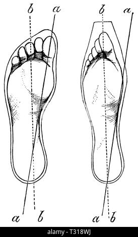 Umano: piedi - piede normale (sinistra), piede deformato (a destra), anonym Foto Stock