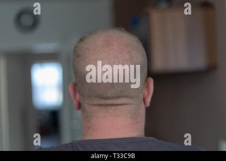 Alopecia umana o la perdita dei capelli - uomini adulti testa calva Foto Stock