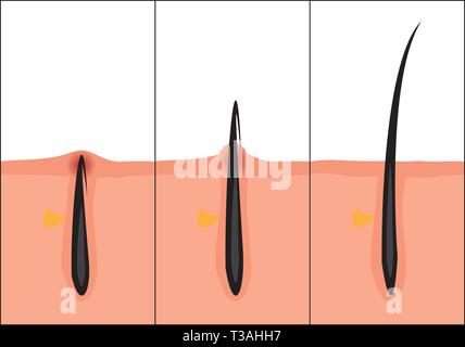 Normale e peli incarniti illustrazione vettoriale. Dermocosmesi problema. Illustrazione Vettoriale