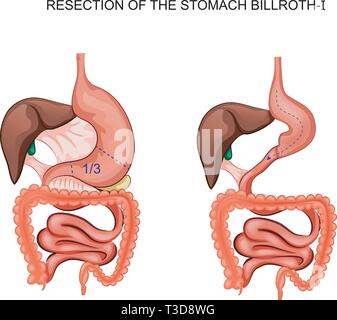 Illustrazione vettoriale di schema della resezione dello stomaco Billroth 1 Illustrazione Vettoriale