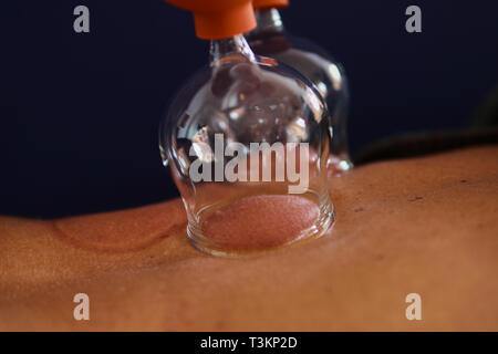 Terapia cupping come una forma alternativa di medicina cinese Foto Stock