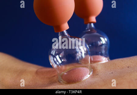 Terapia cupping come una forma alternativa di medicina cinese Foto Stock