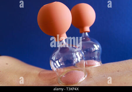 Terapia cupping come una forma alternativa di medicina cinese Foto Stock