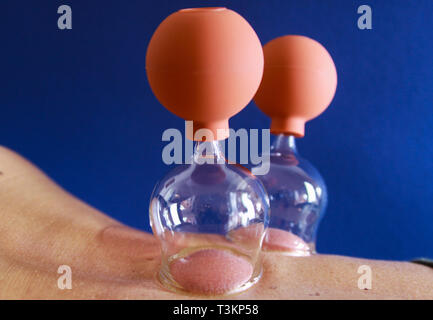 Terapia cupping come una forma alternativa di medicina cinese Foto Stock