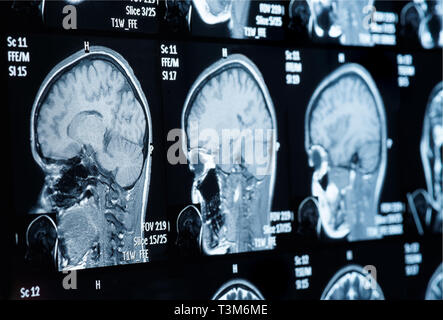 Testa di scansione MRI, dati personali rimosso Foto Stock