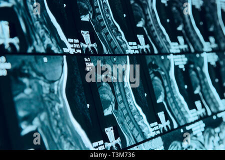 Testa e collo MRI scan, resi anonimi, poco profonda profondità di messa a fuoco Foto Stock