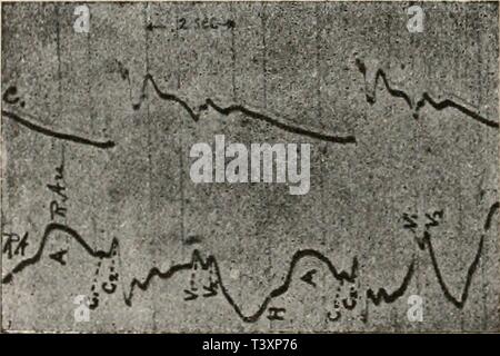 Immagine di archivio da pagina 139 di Die Physiologie des Kreislaufes (1921). Die Physiologie des Kreislaufes diephysiologiede01tige Anno: 1921 Fig. 85. Kammer- und Vorhofdruckkurve vom Hund. Nach Piper. Von rechts nach links zu lesen. Mit diesen Kurven die stimmen von v. Zwaluvenburg und Agnew aufgenom- menen Kurven der Vorhofkontraktion nahe überein (vgl. Fig. 86). Auch hier finden wir nach der Ersten Erhebung bei der Vor- hofsystole eine mehr oder weniger bedeutende Senkung, welche von ein paar neuen Erhebungen, unter denen die zweite (Cg) dem Anfang der Kammersystole entspricht, unterbrochen wi Foto Stock