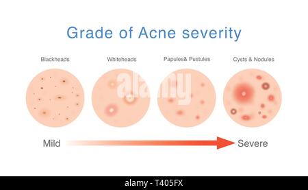 Schema medico circa il grado di gravità di acne. Illustrazione Vettoriale