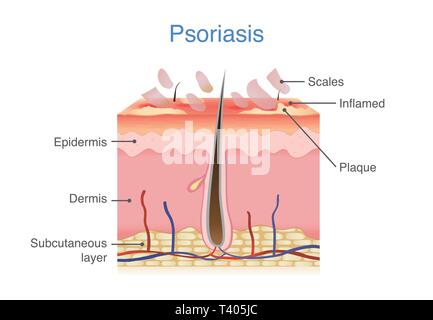 La pelle umana strato quando psoriasi a placche i segni e i sintomi appaiono. Illustrazione Vettoriale
