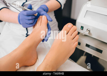 Il trattamento laser su toenail, infezione fungina sulla toenails Foto Stock