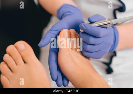 Il trattamento laser su toenail, infezione fungina sulla toenails Foto Stock