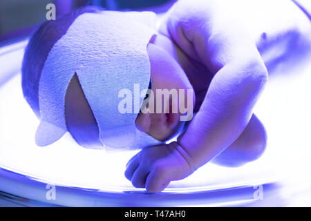 Il bambino si trova sotto una lampada a raggi ultravioletti con ittero Foto Stock