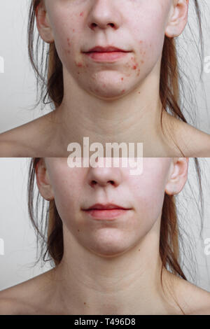 Giovane donna prima e dopo il trattamento di acne, primo piano. Cura della Pelle concept Foto Stock