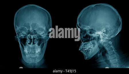 Cranio immagine a raggi x, lesioni al capo x-ray per lession dignosis Foto Stock